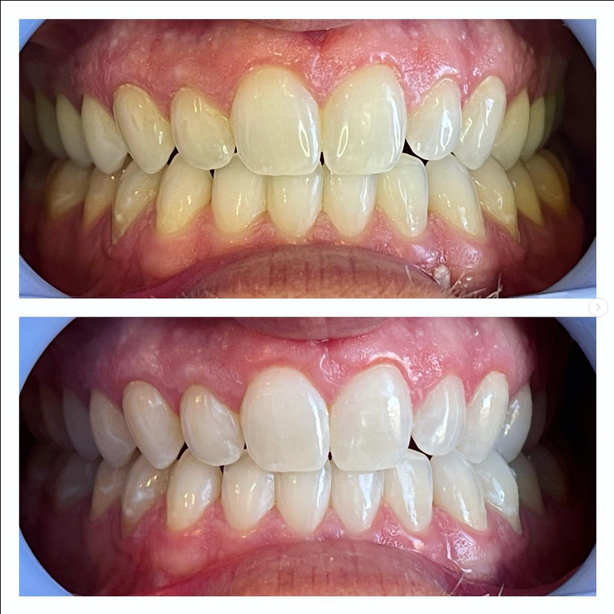 Results Teeth Whitening Utah